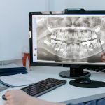 Wisdom Teeth Xray Leander