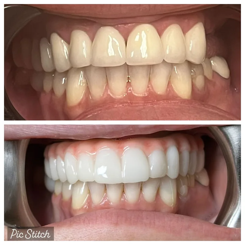 All-on-4 Before After Case 1