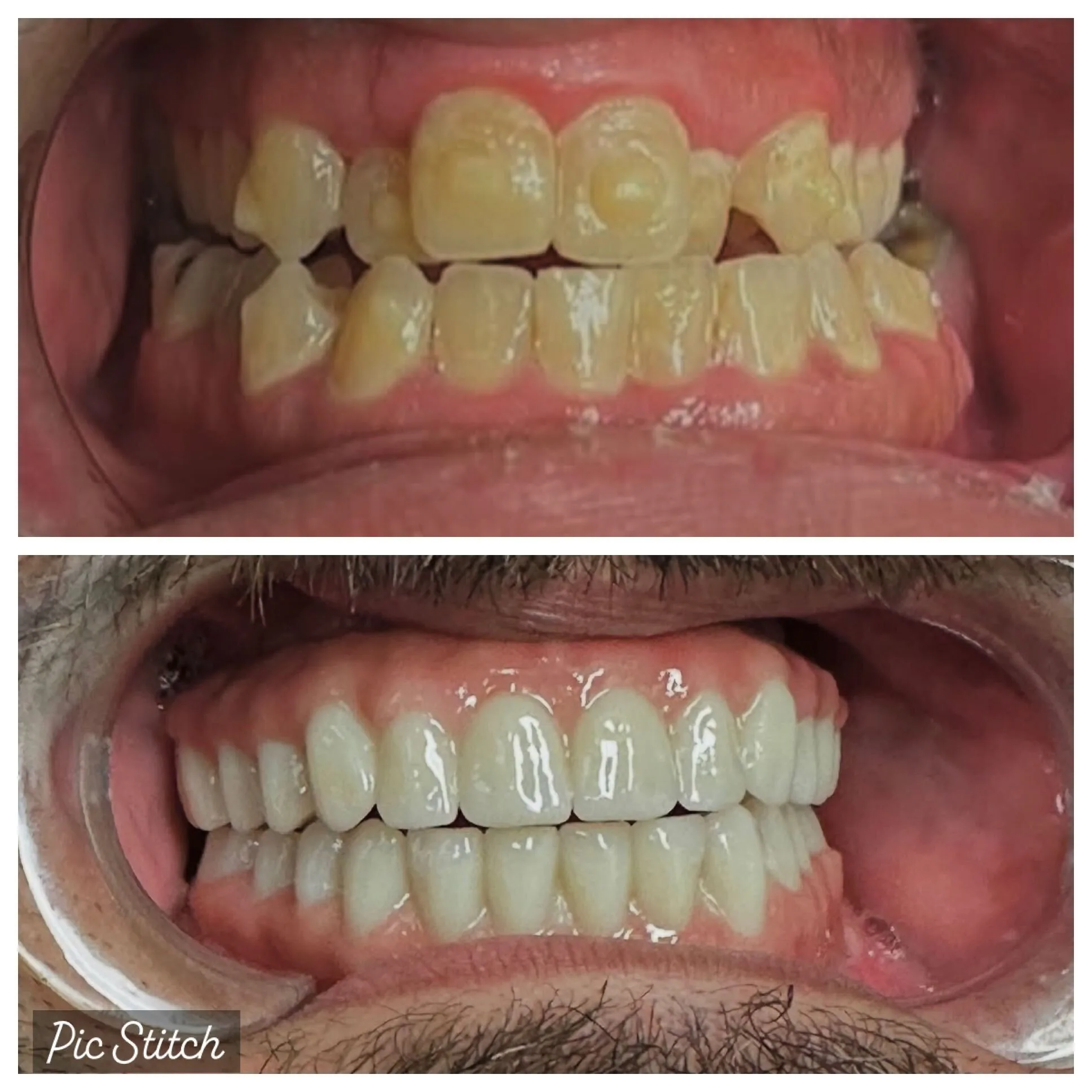 All-on-4 Before After Case 2