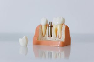 Dental Implant Leander