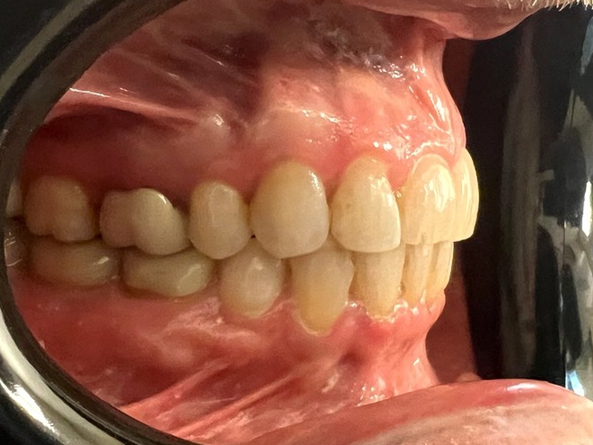 After orthodontic treatment - right lateral view