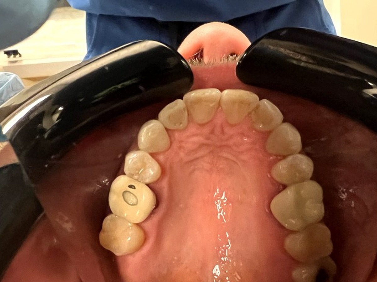 After orthodontic treatment - upper arch occlusal view