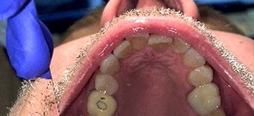 Before orthodontic treatment - upper arch occlusal view