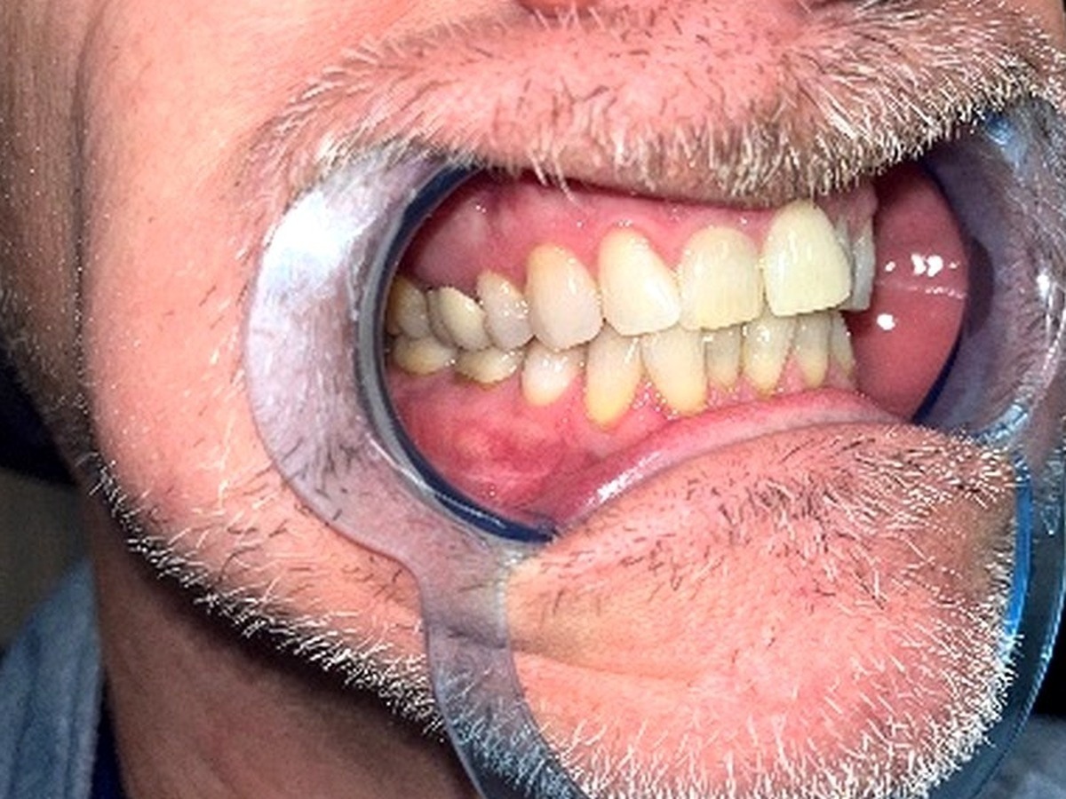 Before orthodontic treatment - right lateral view